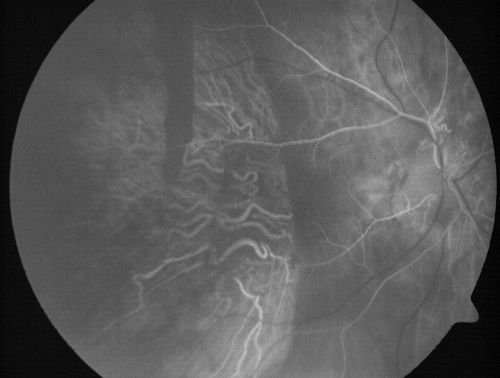 Choriodal Neovascular Membrane - Subfoveal - Pseudo-Retinitis Pigmentosa - 50 years post Retinal Detachment Repair
86-year-old with a history of decreased vision in the right eye.  The patient reports she has lost vision in the right eye over the past two months or so.  She reports the vision was always compromised in that eye since retinal detachment surgery 50 years ago with a scleral buckler. Vision dropped from 20/50 to 20/200 right eye in 2 months.

