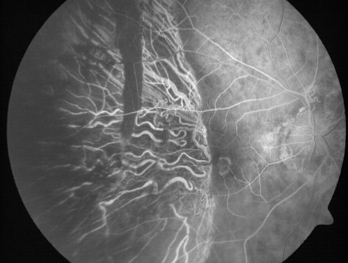 Choriodal Neovascular Membrane - Subfoveal - Pseudo-Retinitis Pigmentosa - 50 years post Retinal Detachment Repair
86-year-old with a history of decreased vision in the right eye.  The patient reports she has lost vision in the right eye over the past two months or so.  She reports the vision was always compromised in that eye since retinal detachment surgery 50 years ago with a scleral buckler. Vision dropped from 20/50 to 20/200 right eye in 2 months.


