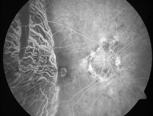 Choriodal Neovascular Membrane - Subfoveal - Pseudo-Retinitis Pigmentosa - 50 years post Retinal Detachment Repair
86-year-old with a history of decreased vision in the right eye.  The patient reports she has lost vision in the right eye over the past two months or so.  She reports the vision was always compromised in that eye since retinal detachment surgery 50 years ago with a scleral buckler. Vision dropped from 20/50 to 20/200 right eye in 2 months.

