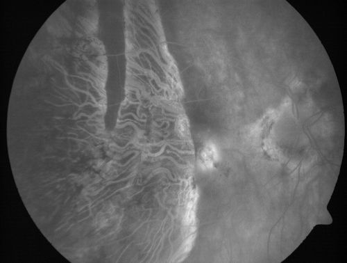 Choriodal Neovascular Membrane - Subfoveal - Pseudo-Retinitis Pigmentosa - 50 years post Retinal Detachment Repair
86-year-old with a history of decreased vision in the right eye.  The patient reports she has lost vision in the right eye over the past two months or so.  She reports the vision was always compromised in that eye since retinal detachment surgery 50 years ago with a scleral buckler. Vision dropped from 20/50 to 20/200 right eye in 2 months.

