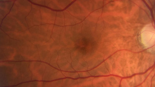 Occult Macular Dystrophy - 9 Years later 
53 year old man.  Vision is better at 20/50 OU
