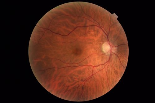 Occult Macular Dystrophy - 9 Years later 
53 year old man.  Vision is better at 20/50 OU
