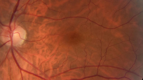 Occult Macular Dystrophy - 
53 year old man.  Vision is better at 20/50 OU
