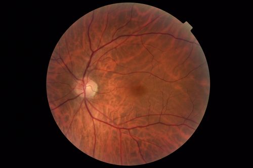 Occult Macular Dystrophy - 9 Years later 
53 year old man.  Vision is better at 20/50 OU
