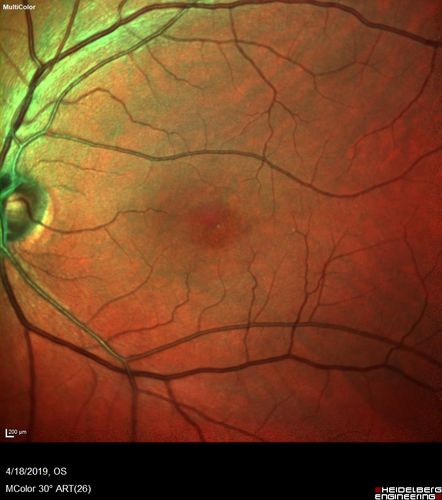 Occult Macular Dystrophy - 9 Years later 
53 year old man.  Vision is better at 20/50 OU
