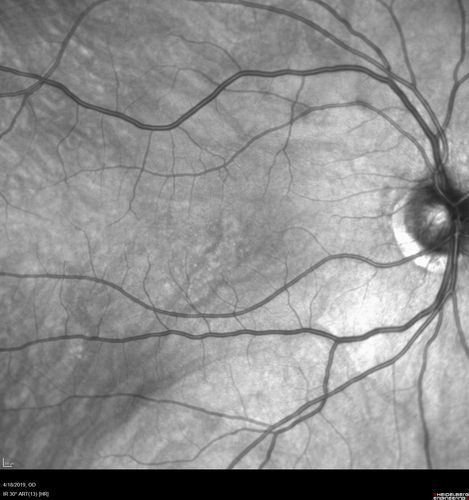 Occult Macular Dystrophy - 9 Years later 
53 year old man.  Vision is better at 20/50 OU
