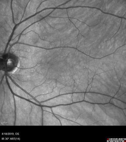 Occult Macular Dystrophy - 9 Years later 
53 year old man.  Vision is better at 20/50 OU
