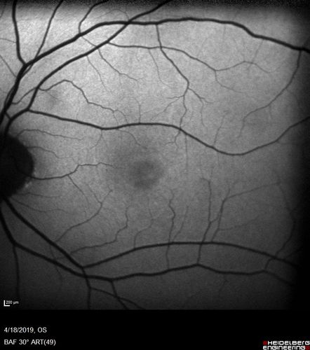 Occult Macular Dystrophy - 9 Years later 
53 year old man.  Vision is better at 20/50 OU
