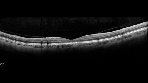 Occult Macular Dystrophy - 9 Years later 
53 year old man.  Vision is better at 20/50 OU
