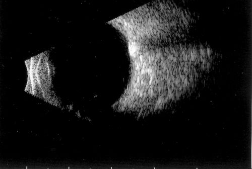 Optic Nerve Head Drusen  B-Scan 
57-year-old woman has optic nerve drusen in both eyes.   
VISUAL ACUITY:  OU 20/20. 
