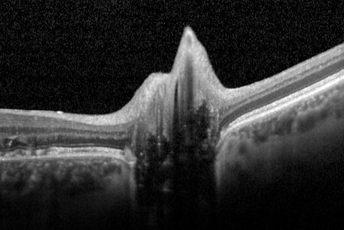 Optic Disk Drusen Advanced Nerve Fiber Loss
