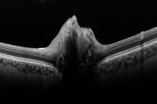 Optic Disk Drusen Advanced Nerve Fiber Loss
