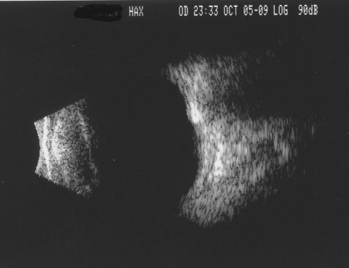 Optic Nerve Drusen in 7 Year Old Child - Miminal Calcification
7-year-old child difficulty seeing the blackboard in school.  She was checked for glasses and it was noted at that time that she had unusual looking optic nerves.  Vision OU is 20/50.  


