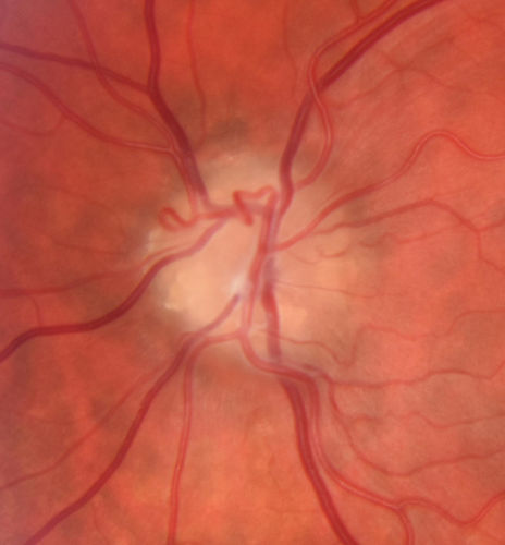 Nerve Fiber Defect from Optic Disk Drusen
31 year old male - asymptomatic
