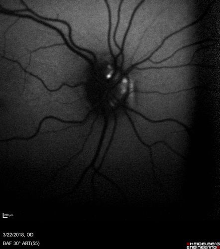 Nerve Fiber Defect from Optic Disk Drusen
31 year old male - asymptomatic
