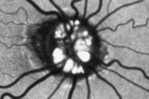 Optic Nerve Drusen -  - Fundus Autofluorescence - FAF
72-year-old woman  has had optic nerve drusen for sometime and has visual field abnormalities. OD 20/32,  OS 20/32. 
