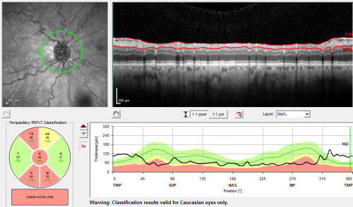 Optic Nerve Drusen -  - Nerve Fiber Layer Scan
72-year-old woman  has had optic nerve drusen for sometime and has visual field abnormalities. OD 20/32,  OS 20/32. 
