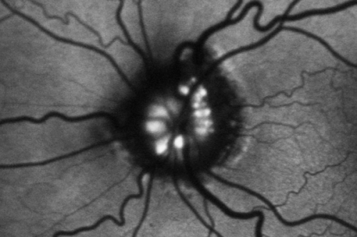 Optic Nerve Drusen -  - Fundus Autofluorescence - FAF
72-year-old woman  has had optic nerve drusen for sometime and has visual field abnormalities. OD 20/32,  OS 20/32. 
