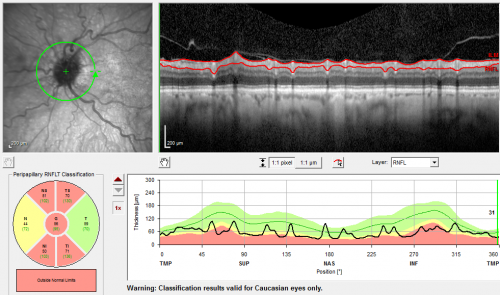 Optic Nerve Drusen - Nerve Fiber Layer Scan
72-year-old woman  has had optic nerve drusen for sometime and has visual field abnormalities. OD 20/32,  OS 20/32. 
