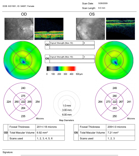 Diabetic and Pseudophakic Cystoid Macular Edema One year followup laser and intravitreal Kenalog with Good Vision
56-year-old woman has diabetic retinopathy in both eyes and macular edema.  She is recently pseudophakic.  OD 20/80, OS 20/200.  1 year ago NOW 20/50 OU
Keywords: cme;bdr;pseudophakic;laser;kenalog