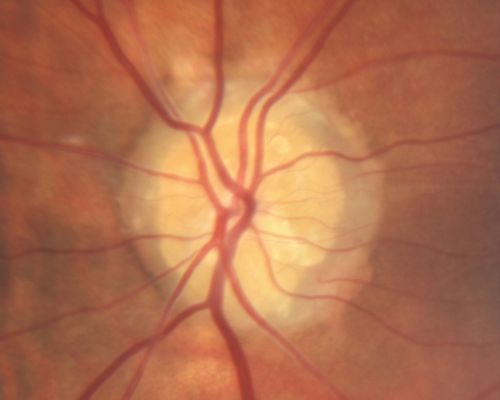 Optic Nerve Head Drusen Left Eye
57-year-old woman has optic nerve drusen in both eyes.   
VISUAL ACUITY:  OU 20/20. 

