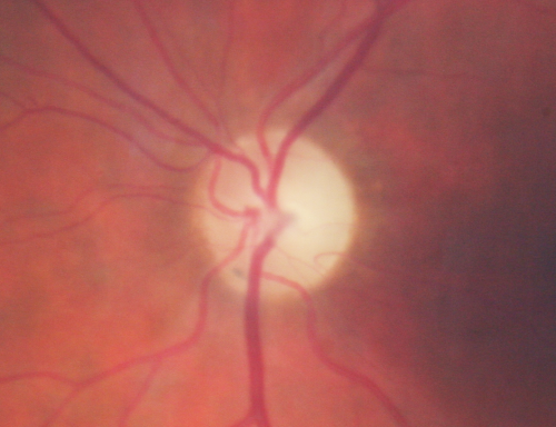 Three years after Injury - Optic Atrophy - Vision is 1/200 in each eye
