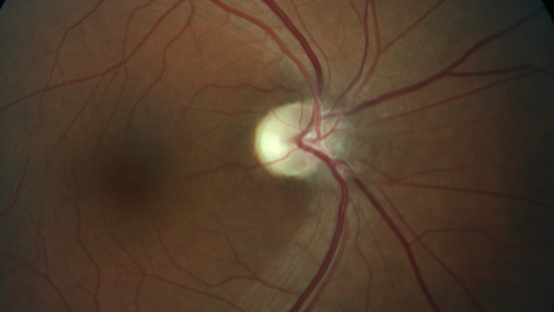 Temporal Pallor - Optic Atrophy - Multiple Sclerosis
42 year old man - Starting about 2 weeks ago he noticed when coming in from walking a dog from bright to dark and when looking at a piece of mail there was a yellow outline on the text that would only last for a few minutes.  The patient has been legally blind for about 6-7 years.  He is legally blind from MS.  
VA OD: DccCF 4ft NccJ16
VA OS: Dcc20/200 PHNI NccJ16
IOP: TP: OD:17 OS:14
