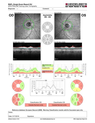 Temporal Pallor - Optic Atrophy - Multiple Sclerosis
42 year old man - Starting about 2 weeks ago he noticed when coming in from walking a dog from bright to dark and when looking at a piece of mail there was a yellow outline on the text that would only last for a few minutes.  The patient has been legally blind for about 6-7 years.  He is legally blind from MS.  
VA OD: DccCF 4ft NccJ16
VA OS: Dcc20/200 PHNI NccJ16
IOP: TP: OD:17 OS:14
