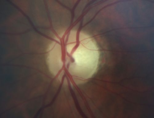 Optic Atrophy Left Eye and  Benign Pituitary Tumor - VA 20/20 Right Eye 20/160 Left Eye
58-year-old man has had gradually declining vision in the left eye over about the last 18 months.  Vision OD is 20/20, OS is 20/160
OCT SCAN:  The OCT scan of the nerve fiber layer in the right eye shows a thickness of 88 microns, the left eye 59 microns.
MRI did show a suprasellar mass which is affecting the optic chiasm and is responsible for the vision loss.  The tumor was resected and was a benign pituitary tumor. 
