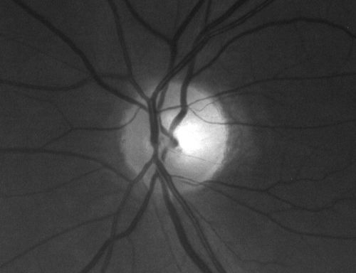 Optic Atrophy Left Eye and  Benign Pituitary Tumor - VA 20/20 Right Eye 20/160 Left Eye
58-year-old man has had gradually declining vision in the left eye over about the last 18 months.  Vision OD is 20/20, OS is 20/160
OCT SCAN:  The OCT scan of the nerve fiber layer in the right eye shows a thickness of 88 microns, the left eye 59 microns.
MRI did show a suprasellar mass which is affecting the optic chiasm and is responsible for the vision loss.  The tumor was resected and was a benign pituitary tumor. 
