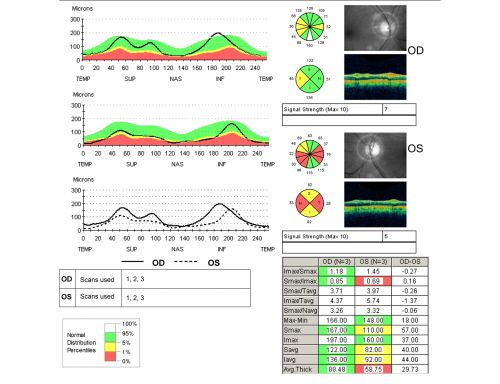 Optic Atrophy Left Eye and  Benign Pituitary Tumor - VA 20/20 Right Eye 20/160 Left Eye
58-year-old man has had gradually declining vision in the left eye over about the last 18 months.  Vision OD is 20/20, OS is 20/160
OCT SCAN:  The OCT scan of the nerve fiber layer in the right eye shows a thickness of 88 microns, the left eye 59 microns.
MRI did show a suprasellar mass which is affecting the optic chiasm and is responsible for the vision loss.  The tumor was resected and was a benign pituitary tumor. 
