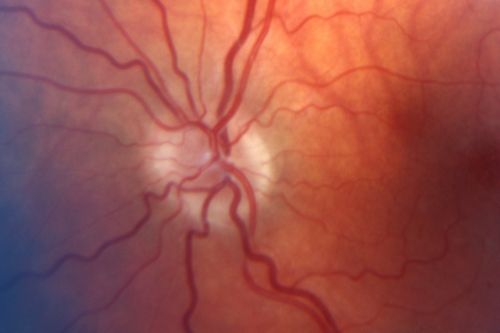 Optic Nerve Hypoplasia
28-year-old man with diabetes and anomalous vessels near nerve. OD is 20/25, OS is 20/20.  IOP:  OD 20, OS 22.
OD:  Vertical C/D ratio is 0.0.  The nerve is tilted and small and there is an anomalous branching pattern of the major retinal vessels.  There is a tuft of irregular telangiectatic vessels on the nasal edge of the optic nerve.  There is also a buried optic nerve druse at the optic margin at 5:00 oâ€™clock.  There are rare retinal hemorrhages in the macula.
OS:   Vertical C/D ratio is 0.0.  Again, the  nerve looks small.  There is an anomalous branching pattern of the retinal vessels and rare retinal hemorrhages. 
