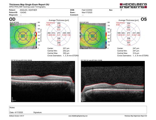 Optic Neuritis sentinel event for MS (23 year old female)
23-year-old female contact lens wearer reports recurrent blurry vision with a central 