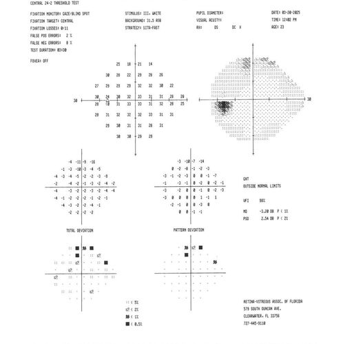 Optic Neuritis sentinel event for MS (23 year old female)
23-year-old female contact lens wearer reports recurrent blurry vision with a central 