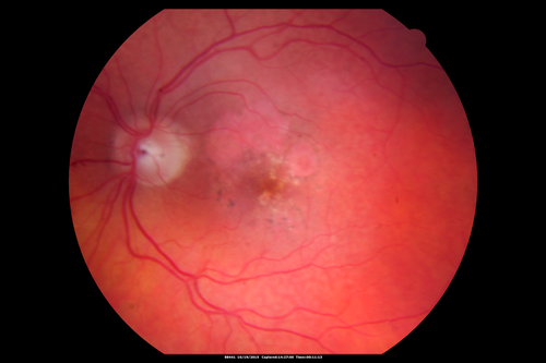 Orbital Cellulitis - Optic nerve compression with ocular ischemia
81 year old woman with constricted eye movement, orbital cellulitis and severe vision loss in the right eye (LP).  She has whitening of the retina and the OCT shows ischemic changes as well as subretinal fluid and blood.  The vision in this eye declined to NLP and the eye remained ischemic despite control of her infection.
