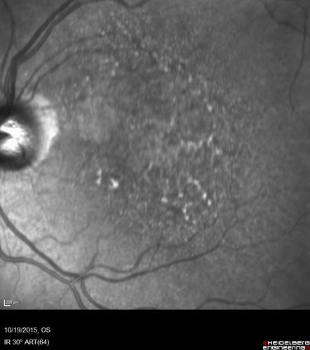 Orbital Cellulitis - Optic nerve compression with ocular ischemia
81 year old woman with constricted eye movement, orbital cellulitis and severe vision loss in the right eye (LP).  She has whitening of the retina and the OCT shows ischemic changes as well as subretinal fluid and blood.  The vision in this eye declined to NLP and the eye remained ischemic despite control of her infection.
