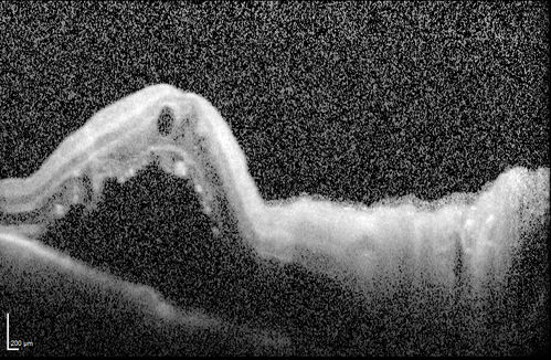 Orbital Cellulitis - Optic nerve compression with ocular ischemia
81 year old woman with constricted eye movement, orbital cellulitis and severe vision loss in the right eye (LP).  She has whitening of the retina and the OCT shows ischemic changes as well as subretinal fluid and blood.  The vision in this eye declined to NLP and the eye remained ischemic despite control of her infection.
