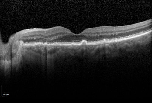 Orbital Cellulitis - Optic nerve compression with ocular ischemia
81 year old woman with constricted eye movement, orbital cellulitis and severe vision loss in the right eye (LP).  She has whitening of the retina and the OCT shows ischemic changes as well as subretinal fluid and blood.  The vision in this eye declined to NLP and the eye remained ischemic despite control of her infection.
