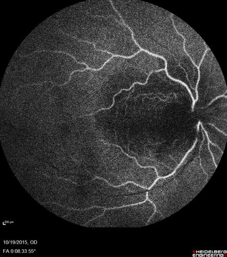 Orbital Cellulitis - Optic nerve compression with ocular ischemia
81 year old woman with constricted eye movement, orbital cellulitis and severe vision loss in the right eye (LP).  She has whitening of the retina and the OCT shows ischemic changes as well as subretinal fluid and blood.  The vision in this eye declined to NLP and the eye remained ischemic despite control of her infection.
