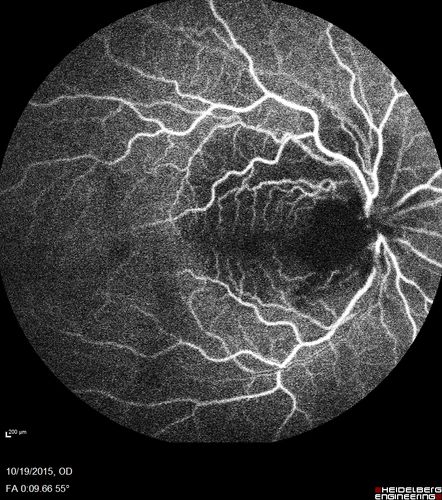 Orbital Cellulitis - Optic nerve compression with ocular ischemia
81 year old woman with constricted eye movement, orbital cellulitis and severe vision loss in the right eye (LP).  She has whitening of the retina and the OCT shows ischemic changes as well as subretinal fluid and blood.  The vision in this eye declined to NLP and the eye remained ischemic despite control of her infection.
