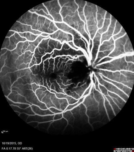 Orbital Cellulitis - Optic nerve compression with ocular ischemia
81 year old woman with constricted eye movement, orbital cellulitis and severe vision loss in the right eye (LP).  She has whitening of the retina and the OCT shows ischemic changes as well as subretinal fluid and blood.  The vision in this eye declined to NLP and the eye remained ischemic despite control of her infection.
