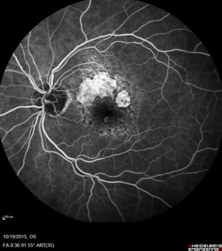 Orbital Cellulitis - Optic nerve compression with ocular ischemia
81 year old woman with constricted eye movement, orbital cellulitis and severe vision loss in the right eye (LP).  She has whitening of the retina and the OCT shows ischemic changes as well as subretinal fluid and blood.  The vision in this eye declined to NLP and the eye remained ischemic despite control of her infection.
