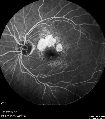 Orbital Cellulitis - Optic nerve compression with ocular ischemia
81 year old woman with constricted eye movement, orbital cellulitis and severe vision loss in the right eye (LP).  She has whitening of the retina and the OCT shows ischemic changes as well as subretinal fluid and blood.  The vision in this eye declined to NLP and the eye remained ischemic despite control of her infection.
