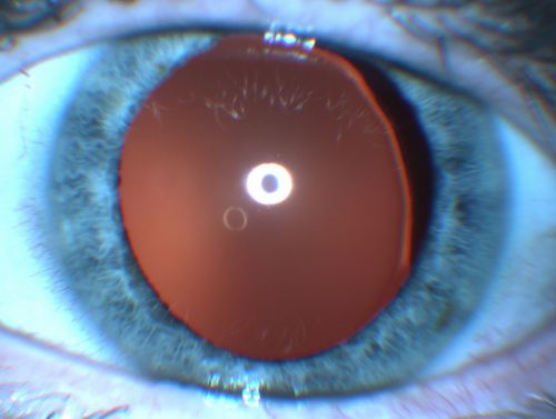 Ectopia Lentis - Marfan's Syndrome - Intermittent Pupillary Block Glaucoma Right Eye
41-year-old woman decreased vision right eye and intermittent pupillary block glaucoma for 6 months from a dislocated natural lens in the eye, probably associated with Marfan syndrome.Vision OD is 20/160, PH 20/40; OS is 20/30, PH 20/25
