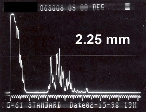 Papilledema 10 year old child
10-year-old child has uveitis in both eyes.  She probably has tubulointerstitial nephritis-uveitis syndrome, and she apparently also independently has idiopathic elevated intracranial pressure.  VISUAL ACUITY: Vision OU is 20/20. 
Keywords: papilledema; child;