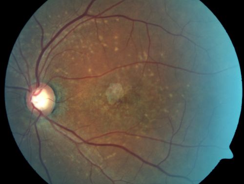 Stargardt's Juvenille Macular Dystrophy - Fundus Flavimaculatus - Famlial
55-year-old woman was seen in the office on 11/18/08.  She has a half sister with Stargardtâ€™s disease and seven other siblings who are fine.  20/120 OD, 20/160 OS.
