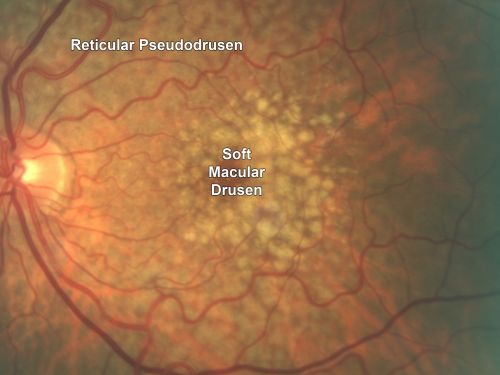 Reticular Macular Disease - Reticular Pseudodrusen and Soft Macular Drusen - 57 Year Old Woman
57-year-old woman was seen in the office on 2/22/2011.  She has macular drusen in both eyes.  I saw her back in 2006.  Since then she does notice slight increased distortion.  OD is 20/25, OS is 20/25
