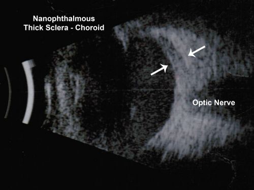 Nanopthalmous (Microphthalmous) Chorioretinal Folds and Choroidal Thickening Both Eyes B-Scan Ultrasound
