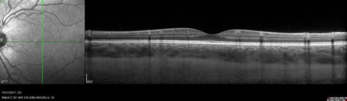 Choroidal Osteoma 13 Year Old
13 year old with 6 months of vision loss right eye and vision of 20/40
