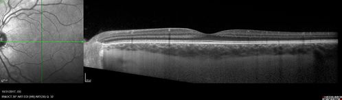 Choroidal Osteoma 13 Year Old
13 year old with 6 months of vision loss right eye and vision of 20/40

